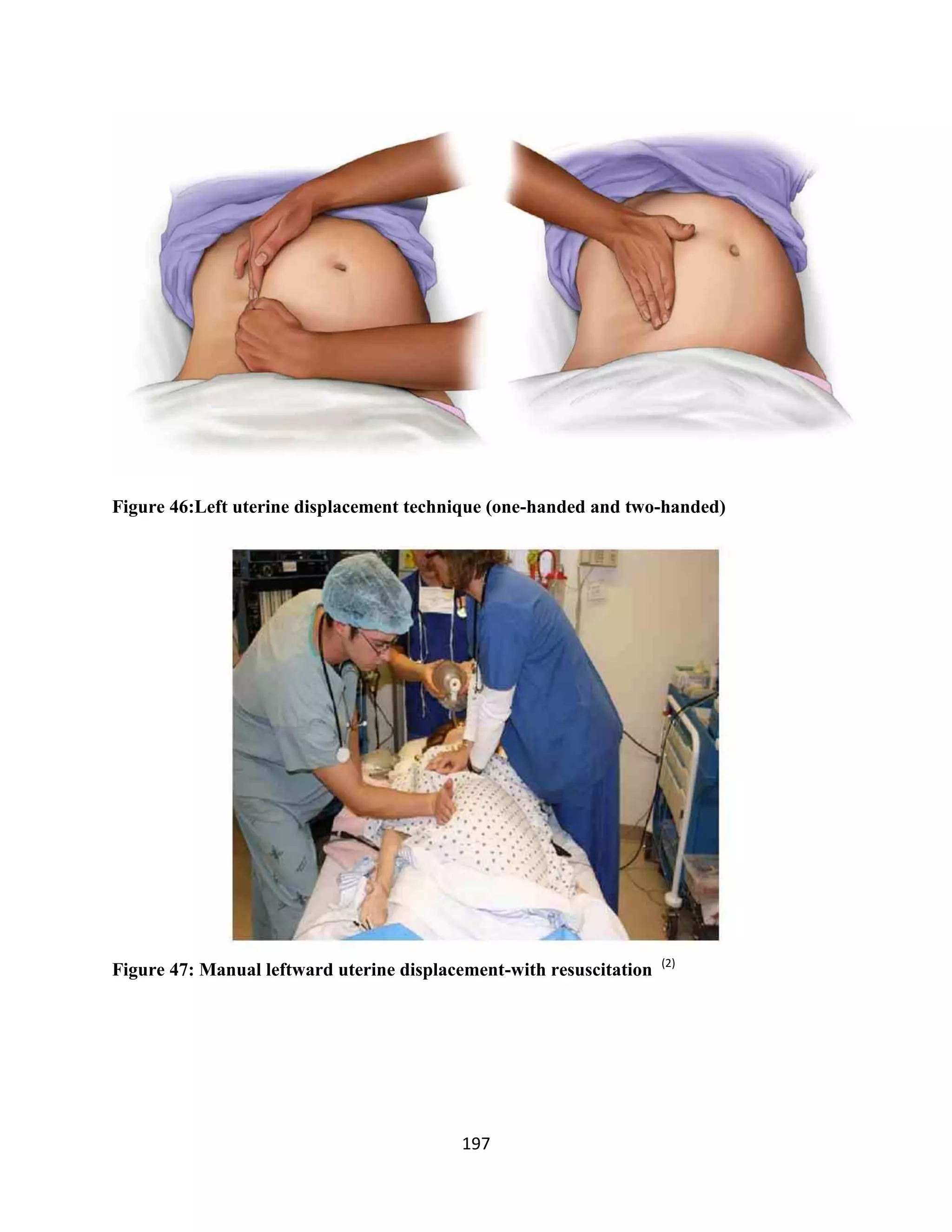197
Figure 46:Left uterine displacement technique (one-handed and two-handed)
Figure 47: Manual leftward uterine displacement-with resuscitation (2)
 