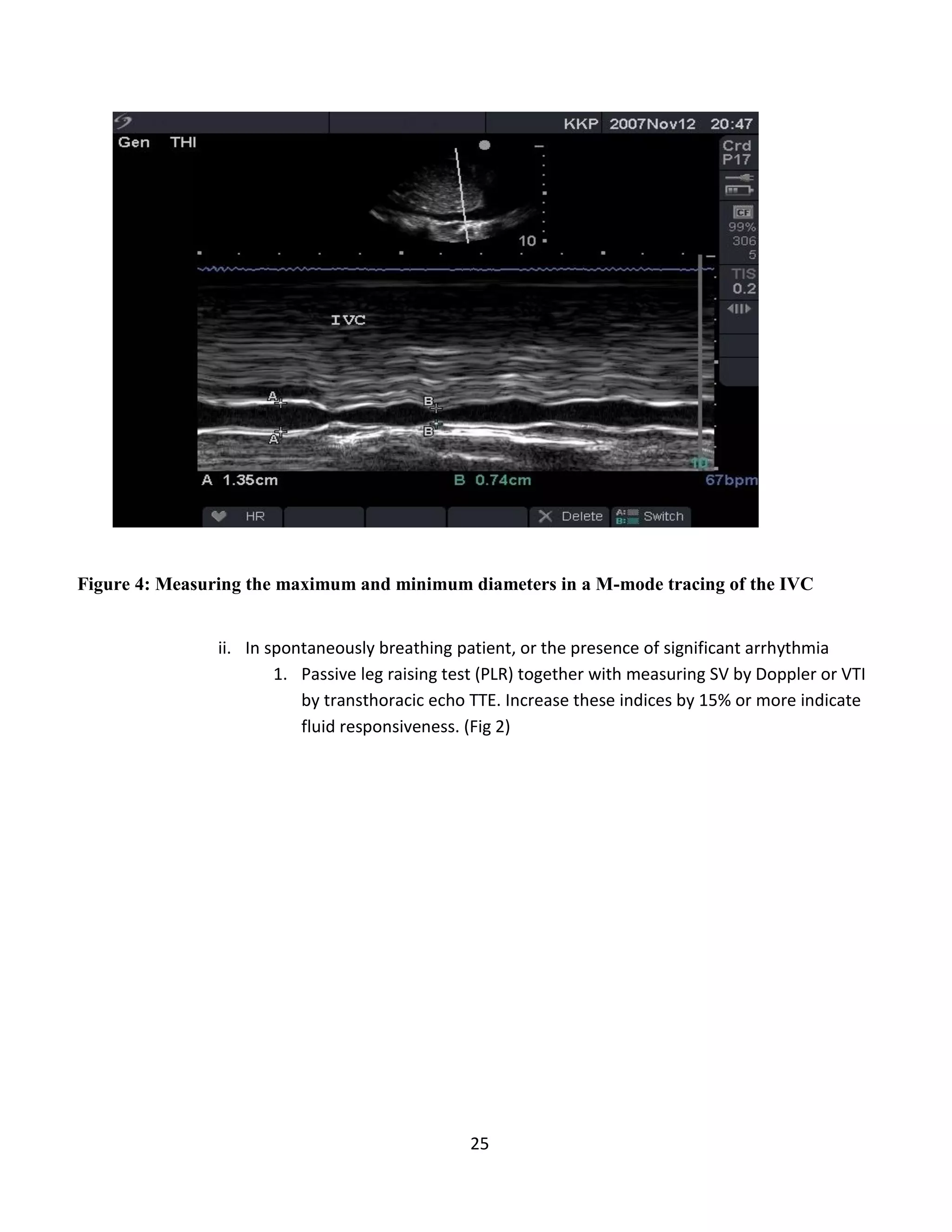 25
Figure 4: Measuring the maximum and minimum diameters in a M-mode tracing of the IVC
ii. In spontaneously breathing patient, or the presence of significant arrhythmia
1. Passive leg raising test (PLR) together with measuring SV by Doppler or VTI
by transthoracic echo TTE. Increase these indices by 15% or more indicate
fluid responsiveness. (Fig 2)
 