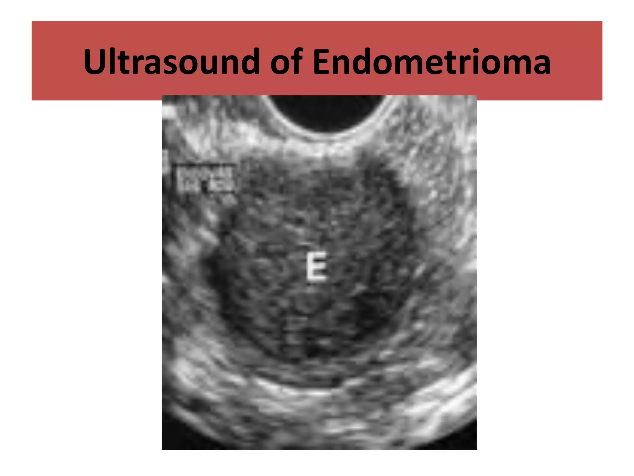 Ultrasound of Endometrioma
 