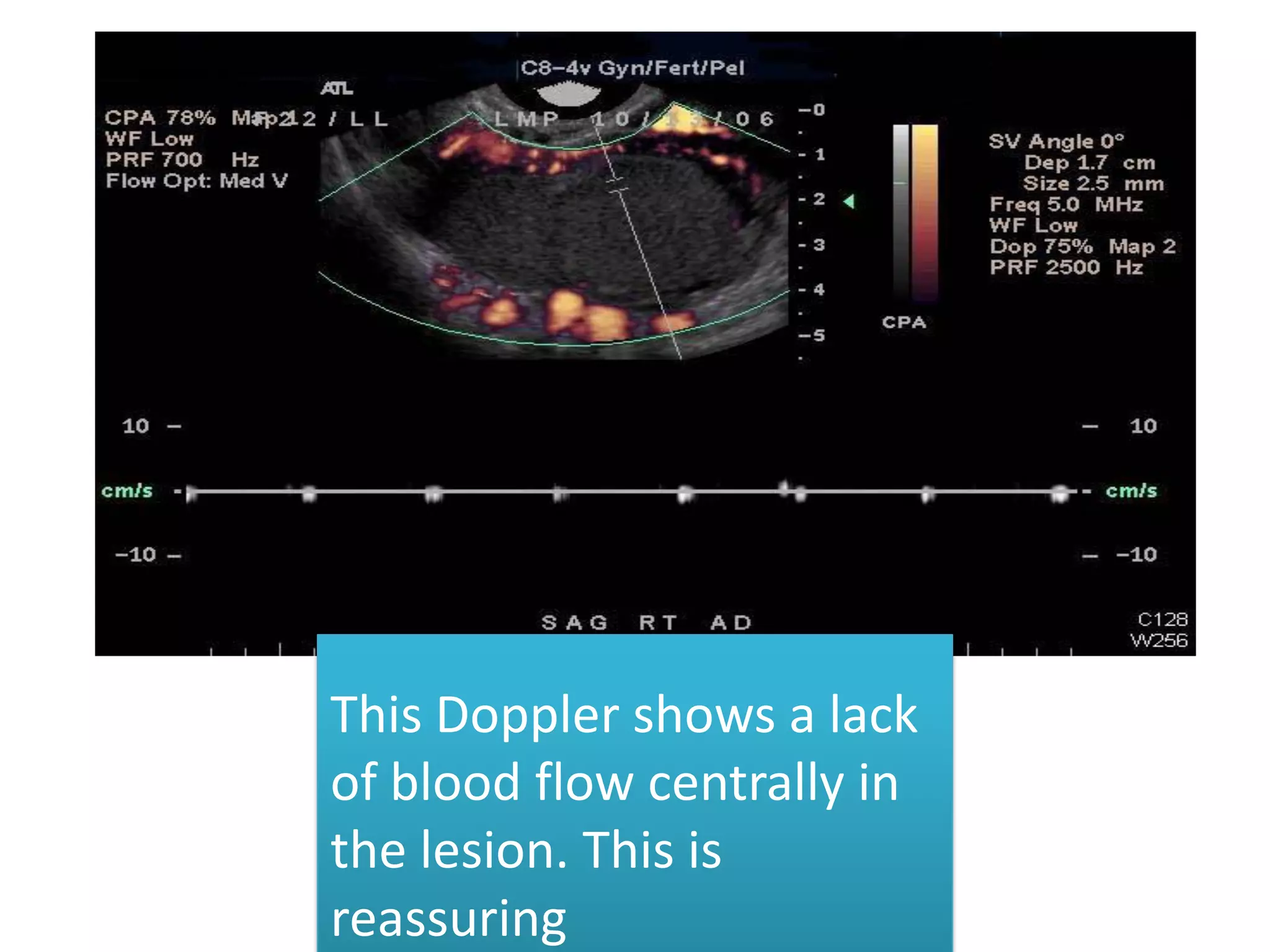 This Doppler shows a lack
of blood flow centrally in
the lesion. This is
reassuring
 
