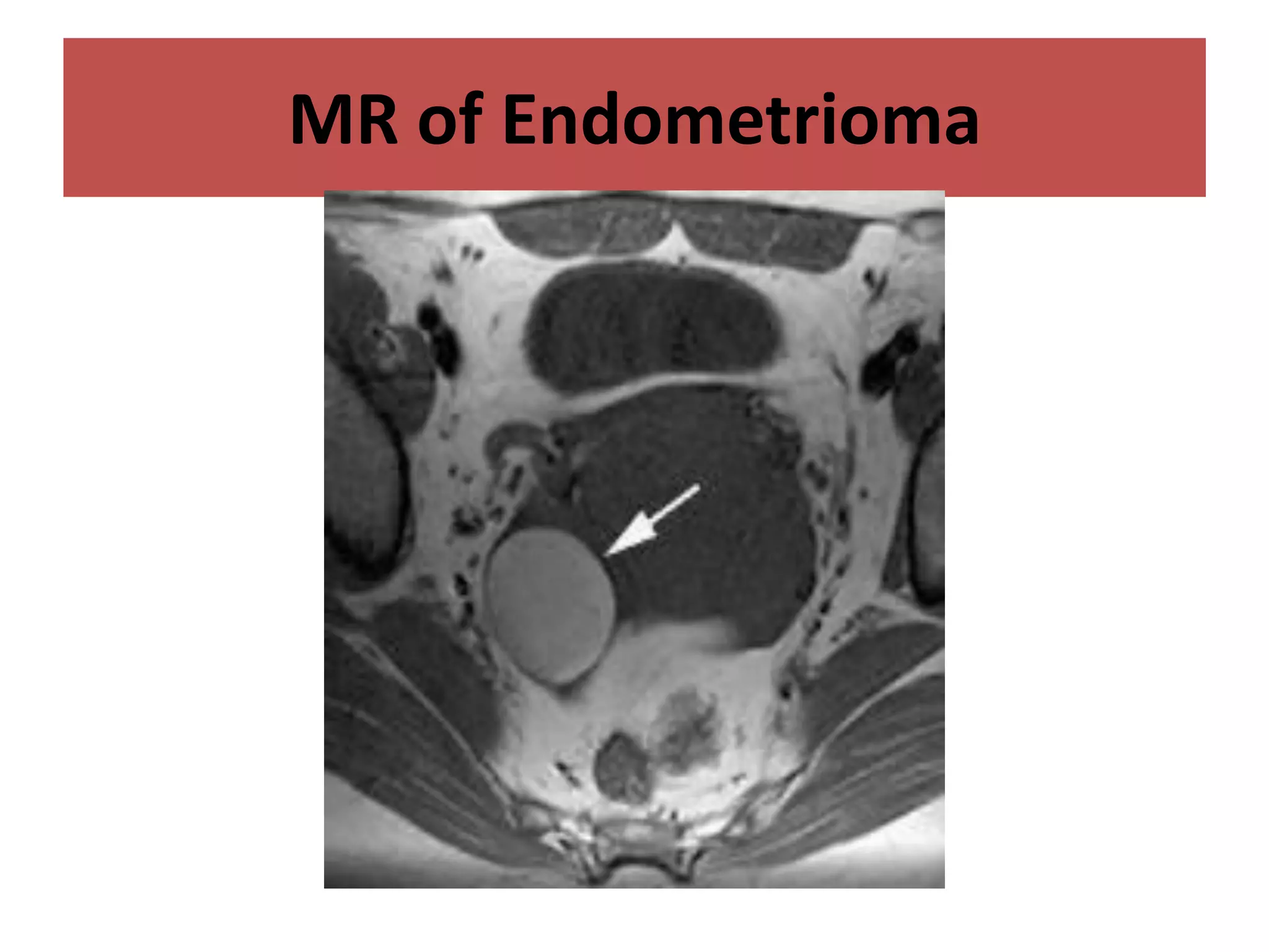 MR of Endometrioma
 