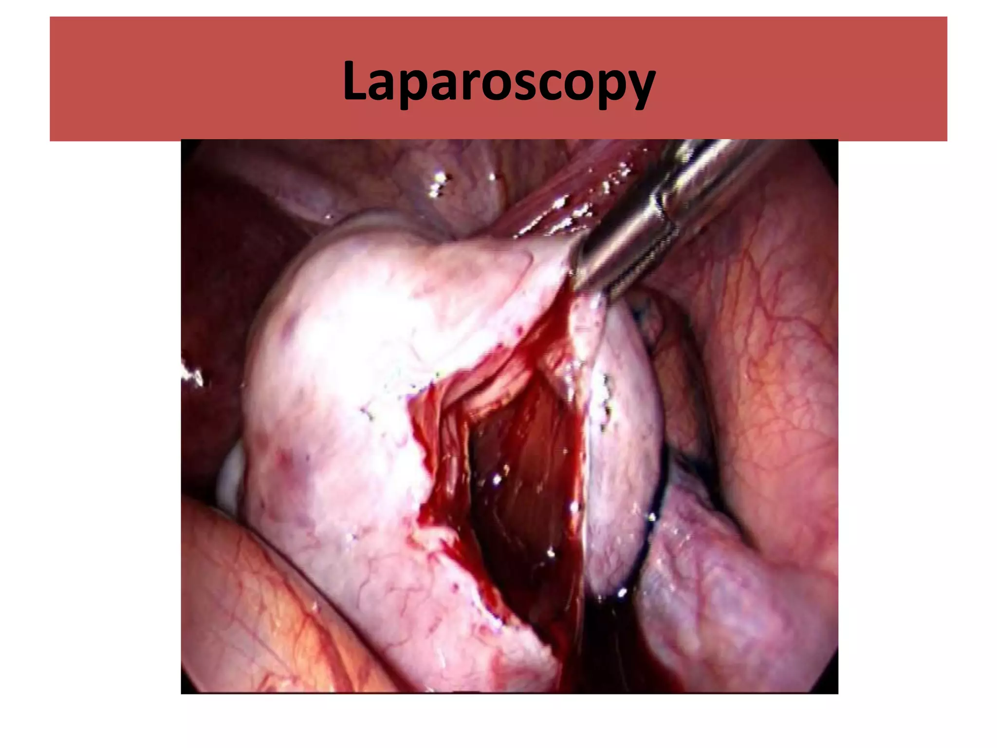Laparoscopy
 