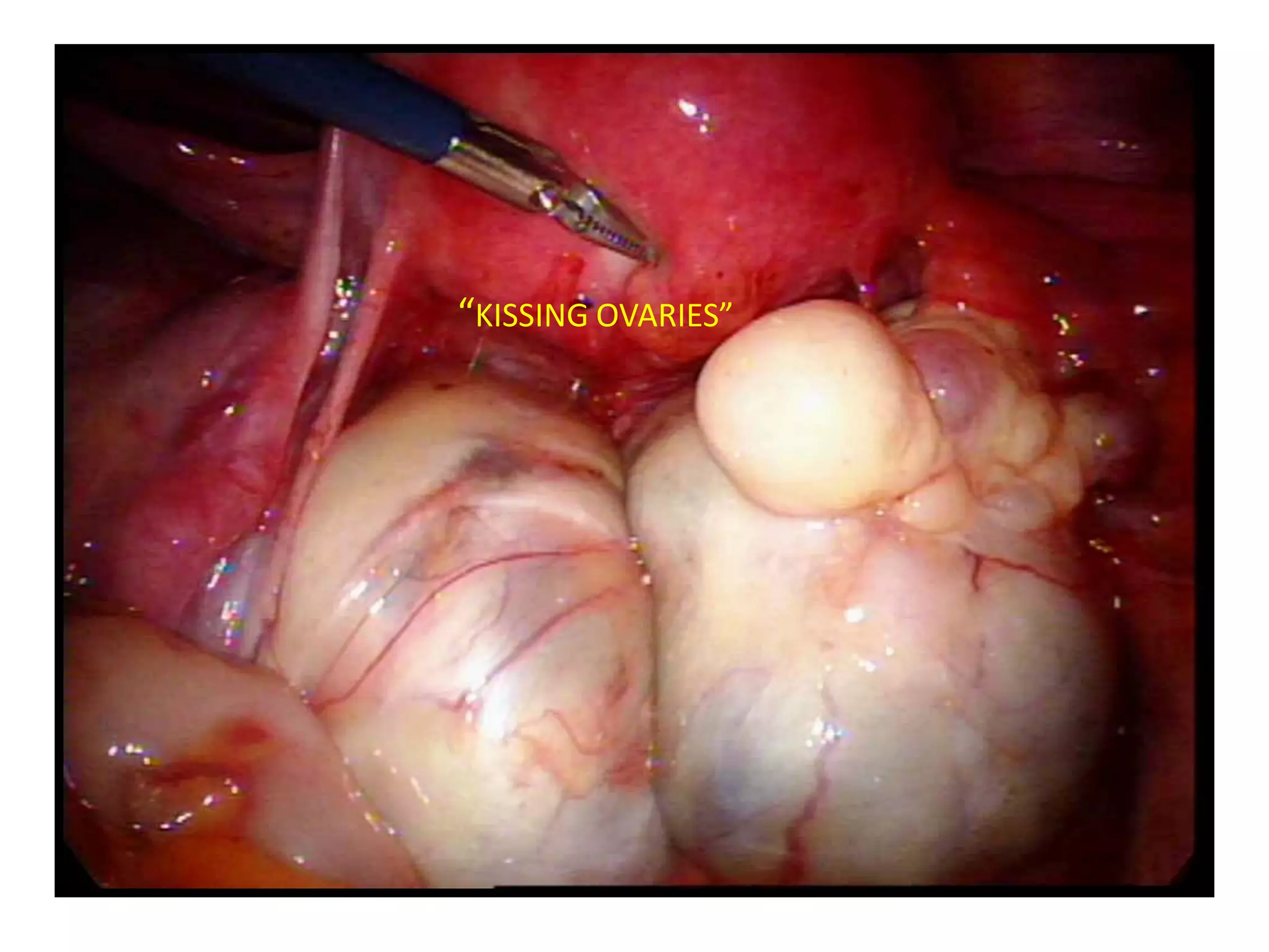 “KISSING OVARIES”
 