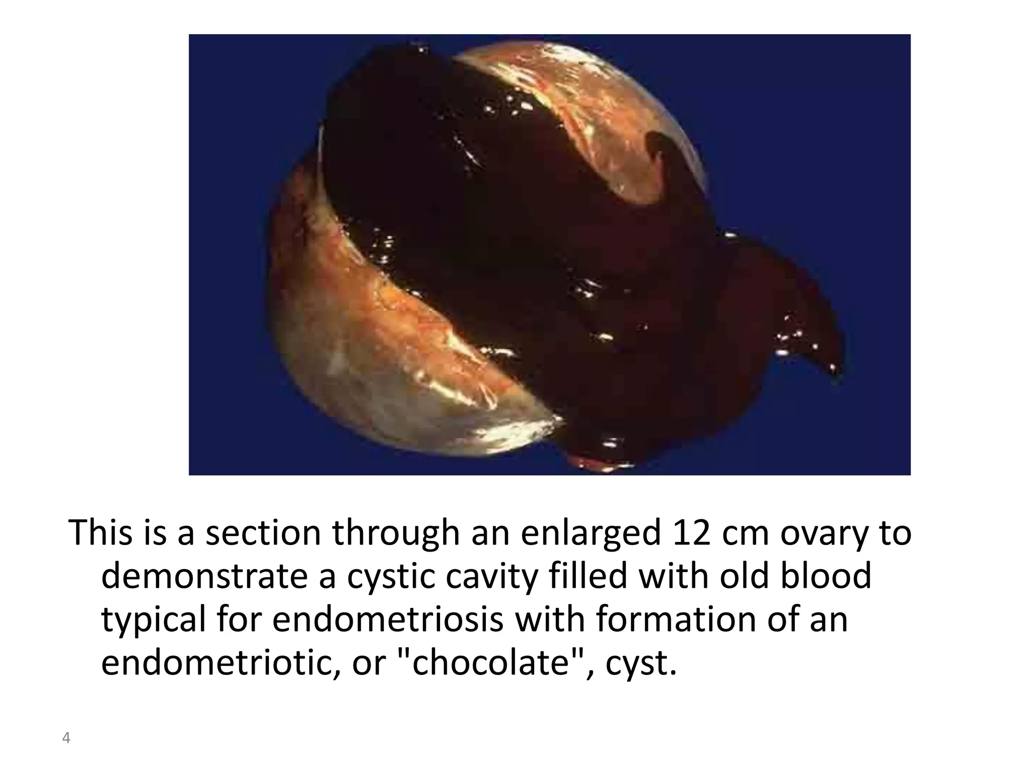 4
This is a section through an enlarged 12 cm ovary to
demonstrate a cystic cavity filled with old blood
typical for endometriosis with formation of an
endometriotic, or "chocolate", cyst.
 