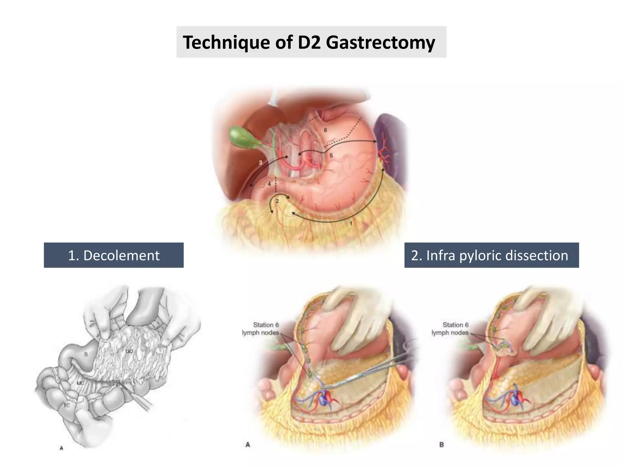 Evidence based Surgical Management of Esophageal and Gastric Cancer | PPTX