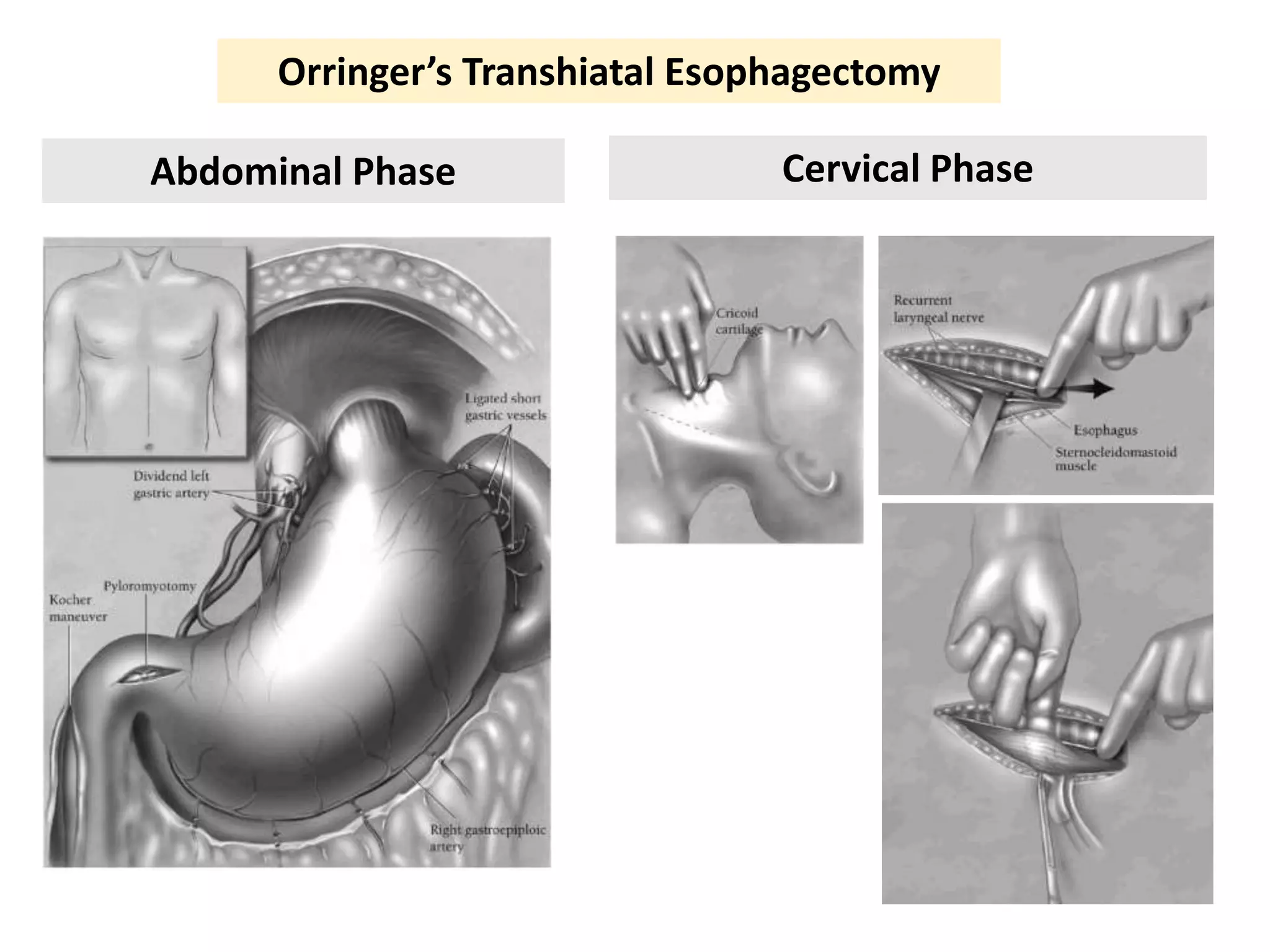 Evidence based Surgical Management of Esophageal and Gastric Cancer | PPTX