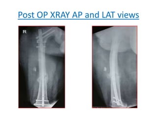 Post OP XRAY AP and LAT views
 