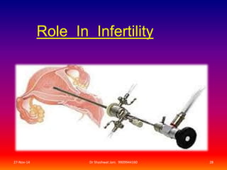 Role In Infertility 
27-Nov-14 Dr Shashwat Jani. 9909944160 28 
 