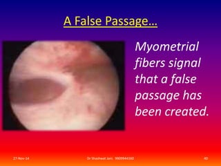 A False Passage… 
Myometrial 
fibers signal 
that a false 
passage has 
been created. 
27-Nov-14 Dr Shashwat Jani. 9909944160 40 
 