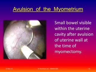 Avulsion of the Myometrium 
Small bowel visible 
within the uterine 
cavity after avulsion 
of uterine wall at 
the time of 
myomectomy. 
27-Nov-14 Dr Shashwat Jani. 9909944160 42 
 