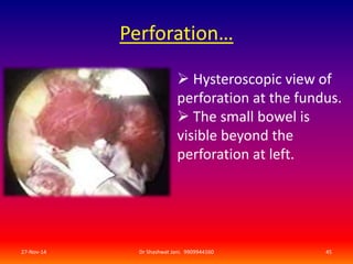 Perforation… 
 Hysteroscopic view of 
perforation at the fundus. 
 The small bowel is 
visible beyond the 
perforation at left. 
27-Nov-14 Dr Shashwat Jani. 9909944160 45 
 