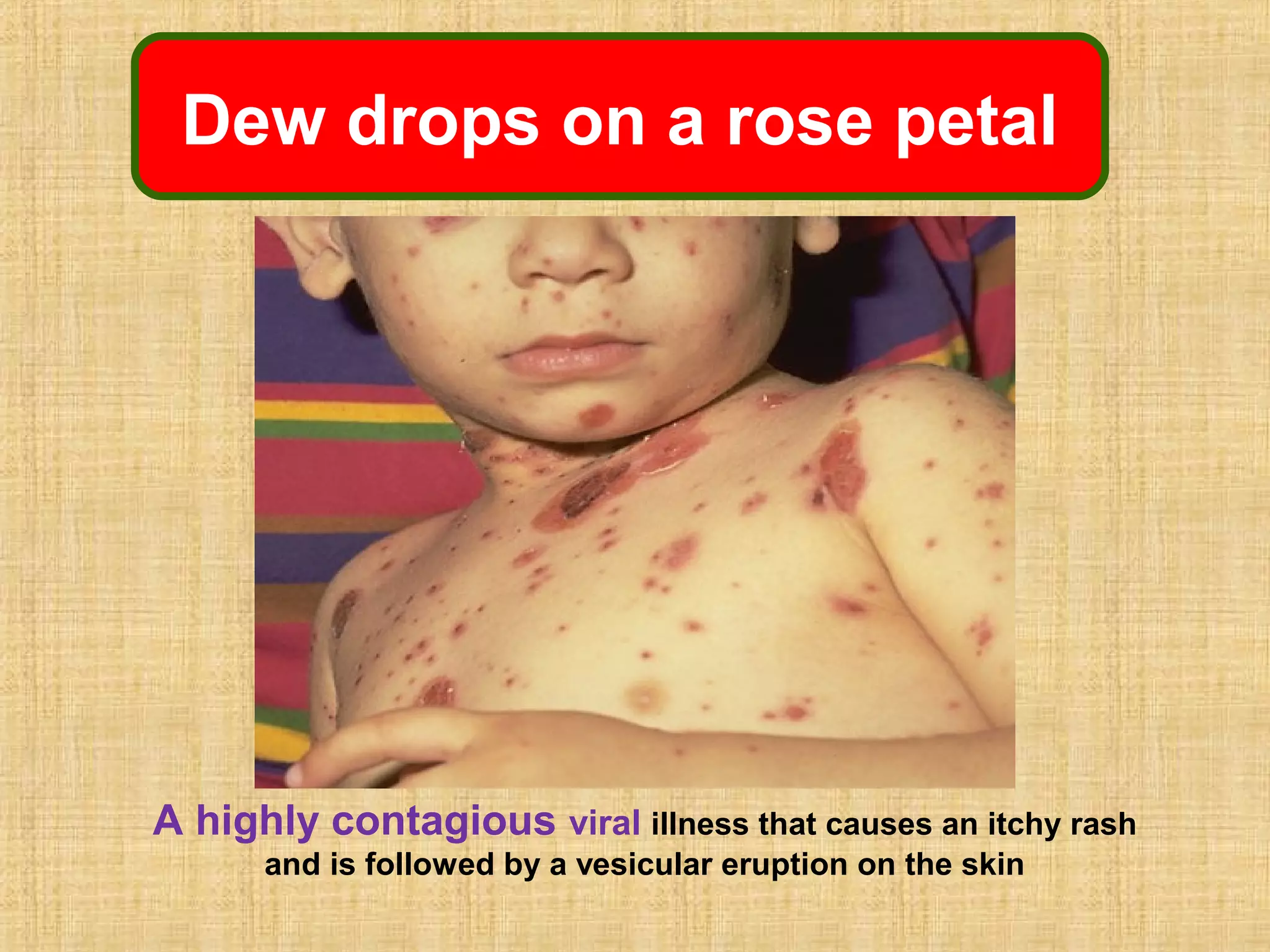 Diffuse Dew Drop Rash Evidence based treatment of chicken poc in pregnancy | PPT