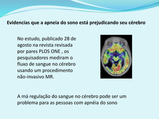 Evidencias que a apneia do sono está prejudicando seu cérebro 
No estudo, publicado 28 de 
agosto na revista revisada 
por pares PLOS ONE , os 
pesquisadores mediram o 
fluxo de sangue no cérebro 
usando um procedimento 
não-invasivo MR. 
A má regulação do sangue no cérebro pode ser um 
problema para as pessoas com apnéia do sono 
 