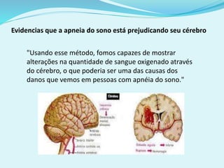 Evidencias que a apneia do sono está prejudicando seu cérebro 
"Usando esse método, fomos capazes de mostrar 
alterações na quantidade de sangue oxigenado através 
do cérebro, o que poderia ser uma das causas dos 
danos que vemos em pessoas com apnéia do sono." 
 