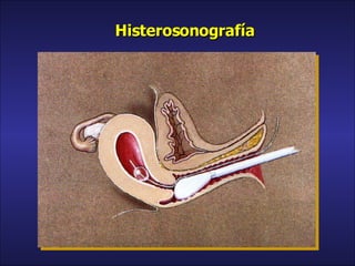 Histerosonografía 