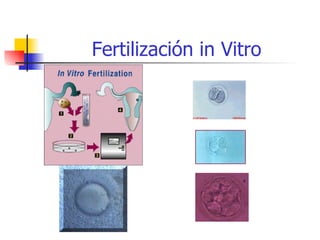 Fertilización in Vitro 