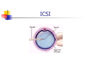 ICSI 