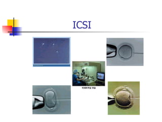 ICSI 