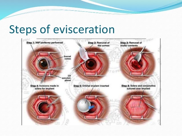 Evisceratio and enucleation(1)