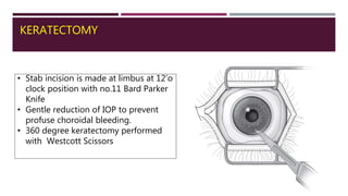 KERATECTOMY
• Stab incision is made at limbus at 12’o
clock position with no.11 Bard Parker
Knife
• Gentle reduction of IOP to prevent
profuse choroidal bleeding.
• 360 degree keratectomy performed
with Westcott Scissors
 