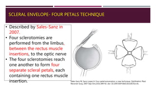 SCLERAL ENVELOPE- FOUR PETALS TECHNIQUE
• Described by Sales-Sanz in
2007.
• Four sclerotomies are
performed from the limbus,
between the rectus muscle
insertions, to the optic nerve
• The four sclerotomies reach
one another to form four
separate scleral petals, each
containing one rectus muscle
insertion. Sales-Sanz M, Sanz-Lopez A. Four-petal evisceration: a new technique. Ophthalmic Plast
Reconstr Surg. 2007 Sep-Oct;23(5):389-92. doi: 10.1097/IOP.0b013e318142cc4c.
 