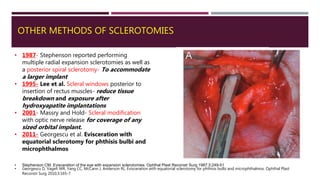 OTHER METHODS OF SCLEROTOMIES
• 1987- Stephenson reported performing
multiple radial expansion sclerotomies as well as
a posterior spiral sclerotomy- To accommodate
a larger implant
• 1995- Lee et al. Scleral windows posterior to
insertion of rectus muscles- reduce tissue
breakdown and exposure after
hydroxyapatite implantations
• 2001- Massry and Hold- Scleral modification
with optic nerve release for coverage of any
sized orbital implant.
• 2011- Georgescu et al. Evisceration with
equatorial sclerotomy for phthisis bulbi and
microphthalmos
• Stephenson CM. Evisceration of the eye with expansion sclerotomies. Ophthal Plast Reconstr Surg 1987;3:249-51
• Georgescu D, Vagefi MR, Yang CC, McCann J, Anderson RL. Evisceration with equatorial sclerotomy for phthisis bulbi and microphthalmos. Ophthal Plast
Reconstr Surg 2010;3:165-7
 