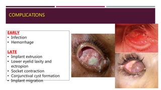 COMPLICATIONS
EARLY
• Infection
• Hemorrhage
LATE
• Implant extrusion
• Lower eyelid laxity and
ectropion
• Socket contraction
• Conjunctival cyst formation
• Implant migration
 
