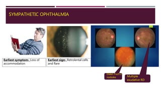 SYMPATHETIC OPHTHALMIA
Earliest symptom- Loss of
accommodation
Earliest sign- Retrolental cells
and flare
Dalen Fuch’s
nodules Multiple
exudative RD
 
