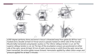 a)360 degree peritomy done and tenon’s tissue is dissected away from globe.(b) All four recti
hooked and a double-armed 6-0 Vicryl suture is passed, locked on either side of the muscle.
Muscle belly transected using bipolar cautery (c) The inferior oblique tendon is cut. (d) The
superior oblique tendon is cut. (e) The tips of the enucleation scissors are positioned on either
side of the optic nerve( At least 10 mm of optic nerve stump is cut)(f) Once the optic nerve has
been transected, the entire globe moves forward. Hemostasis applied by rolled cotton wraps and
pressure applied for at least 5 minutes.
 