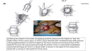 (g) Placing the implant in the socket. (h) Applying posterior pressure to the implant to “seat” the
implant within Tenon’s tissue space. (i) Tenon’s tissue retracted with a toothed forceps while pressure
is being applied posterior to seat the implant (j) The rectus muscles are sutured just short of the
respective fornices with sutures passing through the anterior Tenon’s-conjunctival complex(Myo-
conjunctival technique) (k) Tenon’s is closed under no tension in two layers (l) The conjunctiva is
closed with a running or interrupted 8-0 Vicryl suture.
 