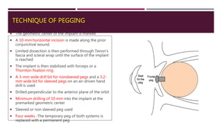 TECHNIQUE OF PEGGING
 The geometric center of the implant is marked
 A 10-mm horizontal incision is made along the prior
conjunctival wound.
 Limited dissection is then performed through Tenon's
fascia and scleral wrap until the surface of the implant
is reached
 The implant is then stabilized with forceps or a
Thornton fixation ring
 A 3-mm wide drill bit for nonsleeved pegs and a 3.2-
mm wide bit for sleeved pegs on an air-driven hand
drill is used
 Drilled perpendicular to the anterior plane of the orbit
 Minimum drilling of 10 mm into the implant at the
premarked geometric center
 Sleeved or non sleeved peg used
 Four weeks -The temporary peg of both systems is
replaced with a permanent peg
 