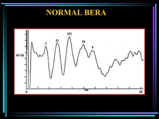 NORMAL BERA
 