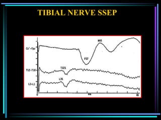 TIBIAL NERVE SSEP
 