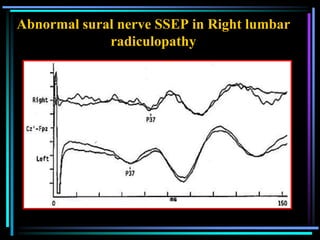 Abnormal sural nerve SSEP in Right lumbar
             radiculopathy
 