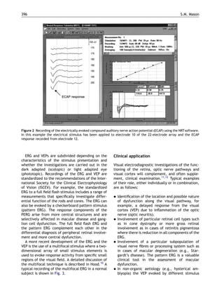 ERG and VEPs are subdivided depending on the
characteristics of the stimulus presentation and
whether the investigations are carried out in the
dark adapted (scotopic) or light adapted eye
(phototopic). Recordings of the ERG and VEP are
standardized to the recommendations of the Inter-
national Society for the Clinical Electrophysiology
of Vision (ISCEV). For example, the standardized
ERG to a full ﬁeld ﬂash stimulus includes a range of
measurements that speciﬁcally investigate differ-
ential function of the rods and cones. The ERG can
also be evoked by a checkerboard pattern stimulus
(pattern ERG). The response components of the
PERG arise from more central structures and are
selectively affected in macular disease and gang-
lion cell dysfunction. The full ﬁeld ﬂash ERG and
the pattern ERG complement each other in the
differential diagnosis of peripheral retinal involve-
ment and more central dysfunction.
A more recent development of the ERG and the
VEP is the use of a multifocal stimulus where a two-
dimensional array of small stimulus elements is
used to evoke response activity from speciﬁc small
regions of the visual ﬁeld. A detailed discussion of
the multifocal technique is described in Hood.10
A
typical recording of the multifocal ERG in a normal
subject is shown in Fig. 3.
Clinical application
Visual electrodiagnostic investigations of the func-
tioning of the retina, optic nerve pathways and
visual cortex will complement, and often supple-
ment, clinical examination.11,12
Typical examples
of their role, either individually or in combination,
are as follows:
 Identiﬁcation of the location and possible nature
of dysfunction along the visual pathway, for
example, a delayed response from the visual
cortex (VEP) due to inﬂammation of the optic
nerve (optic neuritis).
 Involvement of particular retinal cell types such
as in cone dystrophy or more gross retinal
involvement as in cases of retinitis pigmentosa
where there is reduction in all components of the
ERG.
 Involvement of a particular subpopulation of
visual nerve ﬁbres or processing system such as
in cases of macular degeneration (e.g., Star-
gardt’s disease). The pattern ERG is a valuable
clinical tool in the assessment of macular
dysfunction.
 In non-organic aetiology (e.g., hysterical am-
blyopia) the VEP evoked by different stimulus
ARTICLE IN PRESS
Figure 2 Recording of the electrically evoked compound auditory nerve action potential (ECAP) using the NRTsoftware.
In this example the electrical stimulus has been applied to electrode 10 of the 22-electrode array and the ECAP
response recorded from electrode 12.
S.M. Mason396
 