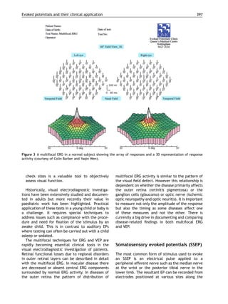 check sizes is a valuable tool to objectively
assess visual function.
Historically, visual electrodiagnostic investiga-
tions have been extensively studied and documen-
ted in adults but more recently their value in
paediatric work has been highlighted. Practical
application of these tests in a young child or baby is
a challenge. It requires special techniques to
address issues such as compliance with the proce-
dure and need for ﬁxation of the stimulus by an
awake child. This is in contrast to auditory EPs
where testing can often be carried out with a child
asleep or sedated.
The multifocal techniques for ERG and VEP are
rapidly becoming essential clinical tools in the
visual electrodiagnostic investigation of patients.
Retinal functional losses due to regional disorders
in outer retinal layers can be described in detail
with the multifocal ERG. In macular disease there
are decreased or absent central ERG components
surrounded by normal ERG activity. In diseases of
the outer retina the pattern of distribution of
multifocal ERG activity is similar to the pattern of
the visual ﬁeld defect. However this relationship is
dependent on whether the disease primarily affects
the outer retina (retinitis pigmentosa) or the
ganglion cells (glaucoma) or optic nerve (ischemic
optic neuropathy and optic neuritis). It is important
to measure not only the amplitude of the response
but also the timing as some diseases affect one
of these measures and not the other. There is
currently a big drive in documenting and comparing
disease-related ﬁndings in both multifocal ERG
and VEP.
Somatosensory evoked potentials (SSEP)
The most common form of stimulus used to evoke
an SSEP is an electrical pulse applied to a
peripheral afferent nerve such as the median nerve
at the wrist or the posterior tibial nerve in the
lower limb. The resultant EP can be recorded from
electrodes positioned at various sites along the
ARTICLE IN PRESS
Figure 3 A multifocal ERG in a normal subject showing the array of responses and a 3D representation of response
activity (courtesy of Colin Barber and Yaqin Wen).
Evoked potentials and their clinical application 397
 