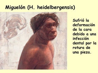 Miguelón (H. heidelbergensis)
Sufrió la
deformación
de la cara
debido a una
infección
dental por la
rotura de
una pieza.
 