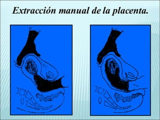 Extracción manual de la placenta. 