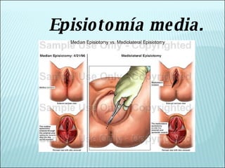 Episiotomía media. 