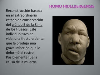 Reconstrucción basada
en el extraordinario
estado de conservación
del cráneo 5 de la Sima
de los Huesos. Este
individuo tuvo en
vida, una fractura dental
que le produjo una
grave infección que le
deformó el rostro.
Posiblemente fue la
causa de la muerte.
 