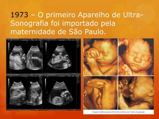 1973 – O primeiro Aparelho de Ultra-
Sonografia foi importado pela
maternidade de São Paulo.
 