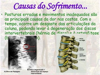 Causas do Sofrimento... Posturas erradas e movimentos inadequados são as principais causas da dor nas costas. Com o tempo, ocorre um desgaste das articulações da coluna, podendo levar à degeneração dos discos intervertebrais (hérnia de disco) e à osteofitose (bico de papagaio).  B) Disco degenerado + diminuição do espaço intervertebral A) Bico de Papagaio 