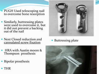  PUGH Used telescoping nail
to overcome bone resorption
 Similarly, buttressing plates
were used to overcome it, but
it did not prevent a backing
out of the nail
 Next Closed reduction and
cannulated screw fixation
 HRA with Austin moore &
Thompson prosthesis
 Bipolar prosthesis
 THR
 Buttressing plate
 