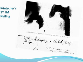 Küntscher’s
1st IM
Nailing
 