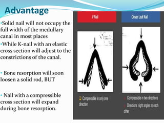 Advantage
•Solid nail will not occupy the
full width of the medullary
canal in most places
•While K-nail with an elastic
cross section will adjust to the
constrictions of the canal.
• Bone resorption will soon
loosen a solid rod, BUT
• Nail with a compressible
cross section will expand
during bone resorption.
 
