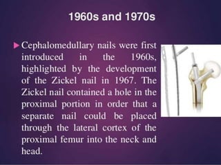  AO group used his
experience to give way
for current generation of
interlocking nailing
system
 