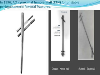 In 1996, AO - proximal femoral nail (PFN) for unstable
peritrochanteric femoral fractures.
 