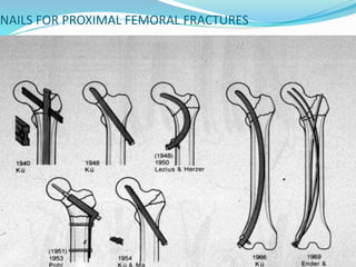 NAILS FOR PROXIMAL FEMORAL FRACTURES
 