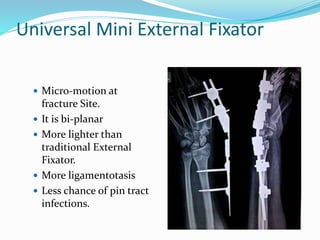 Universal Mini External Fixator
 Micro-motion at
fracture Site.
 It is bi-planar
 More lighter than
traditional External
Fixator.
 More ligamentotasis
 Less chance of pin tract
infections.
 