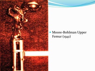  Moore-Bohlman Upper
Femur (1941)
 